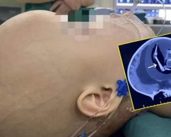 12 Aylık Bebekte Kafatasında Gelişimini Tamamlamamış Fetüs Tespit Edildi